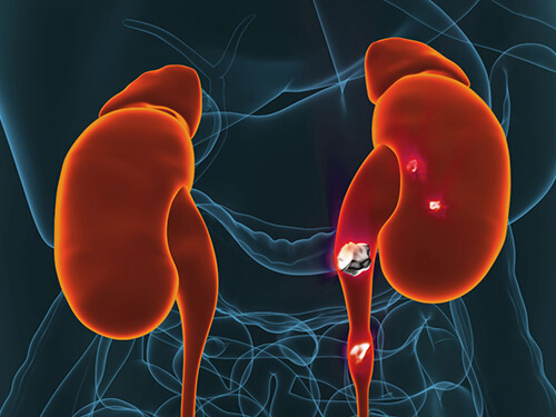 //menshealthmanhattan.com/wp-content/uploads/2024/06/kidney-stones.jpg